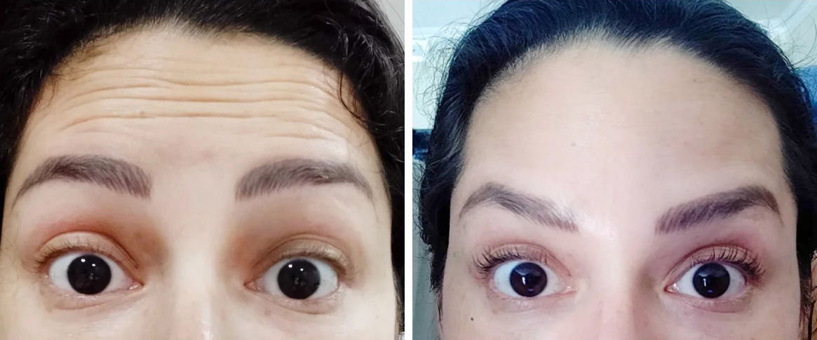 Botox Injection Before After