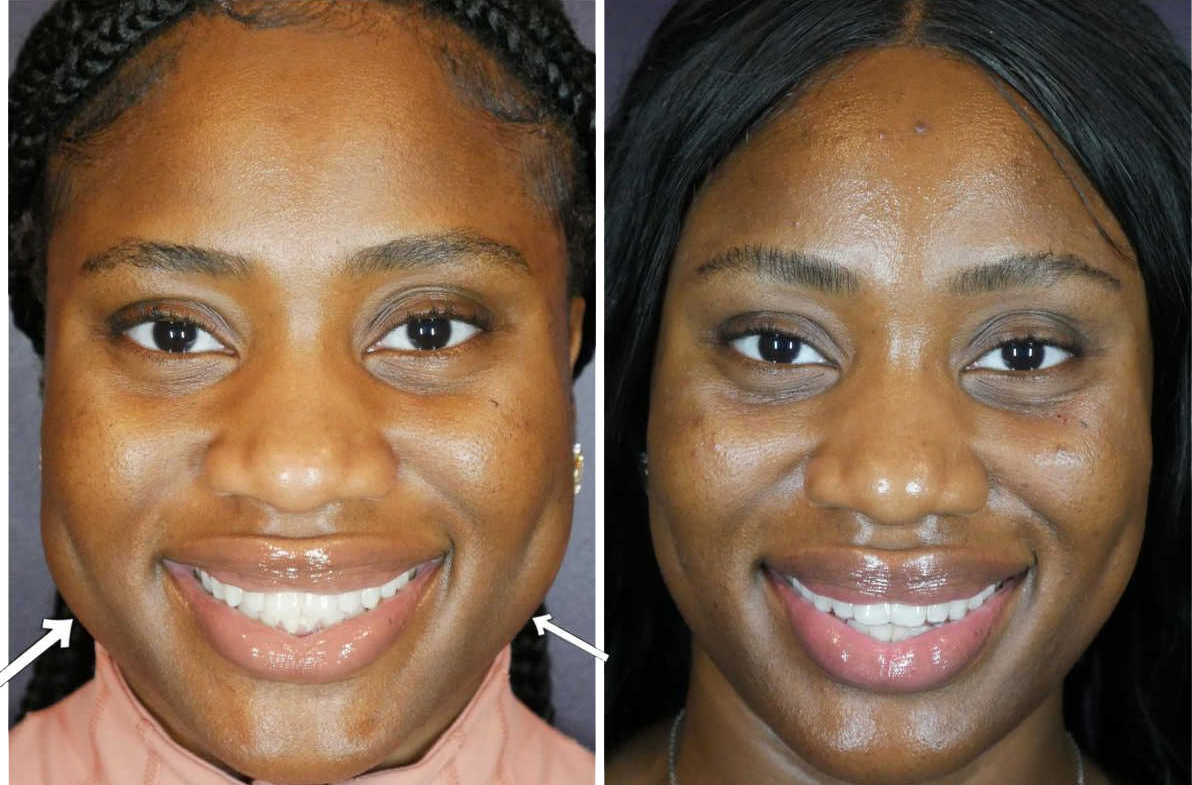 Face Slimming
