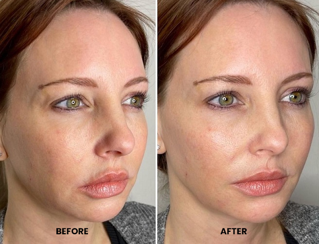 Prf Injection For The Face