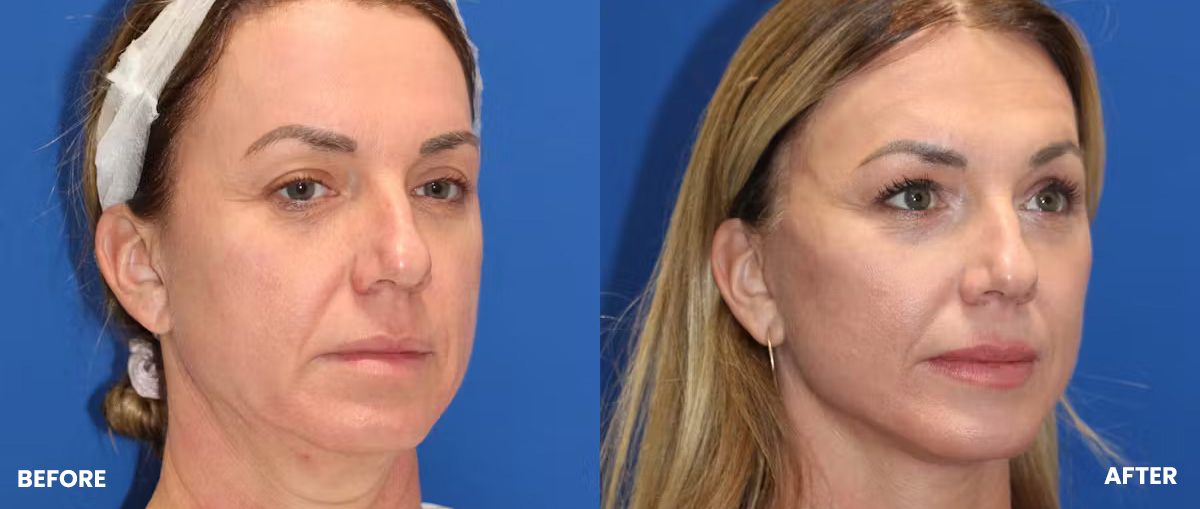 Exosome Skin Regeneration